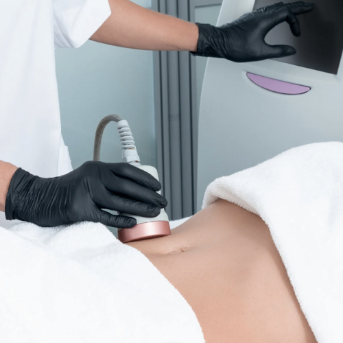 radio frequency treatment illustration